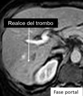 D) RM T2 coronal: se evidencia un CHC por encima de la trombosis portal tumoral. La restricción en la difusión puede estar presente en la trombosis tumoral o en la trombosis aguda.