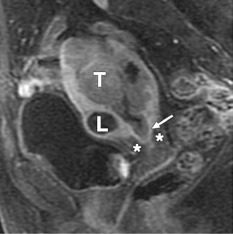 extensión del tumor al conducto del cérvix (flecha en A). Nótese la preservación de la hipointensidad de señal normal del estroma cervical (asteriscos).