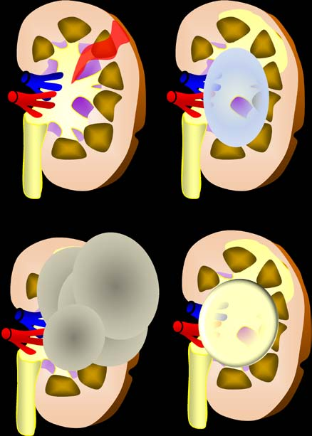 Indicaciones La nefrectomía está indicada cuando el parénquima renal está dañado y no es posible recuperarlo: -Traumatismo renal. -Hidronefrosis.