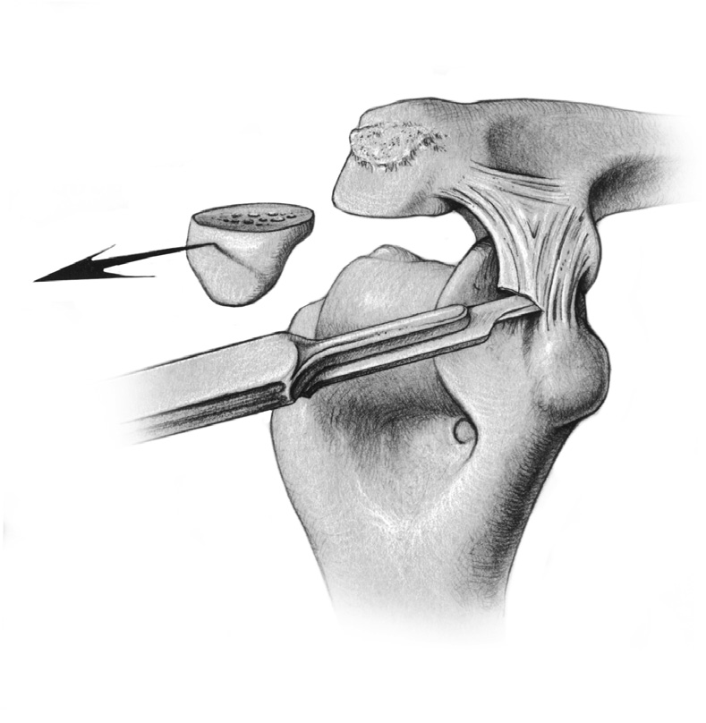 Realice una incisión en línea recta de unos 15 cm de longitud y centrada inmediatamente lateral al epicóndilo medial e inmediatamente medial a la punta del