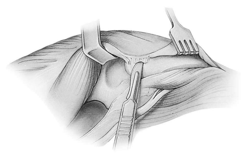 Cresta cubital Realice una incisión por encima de la cara medial del cúbito y eleve el periostio cubital junto con la fascia antebraquial (Fig. 3).