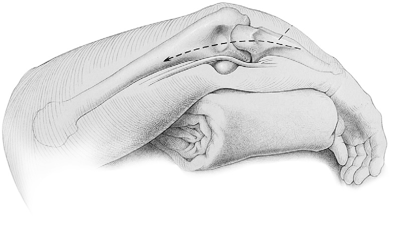 Desprenda el tríceps del cúbito proximal liberando las fibras de Sharpey de su inserción.