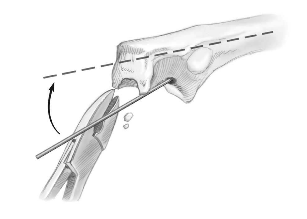 Coloque un dedo sobre la diáfisis proximal expuesta del cúbito para impedir un posible rebasamiento del canal medular (Fig. 18). Abra más el canal con el Raspador Piloto.