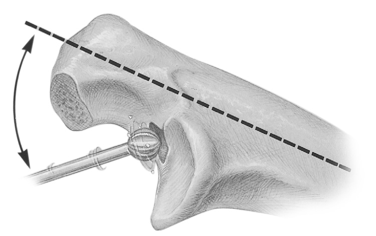 Si implanta el componente cubital extrapequeño, el Raspador de Inicio es el raspador final, y tiene que quedar alojado por completo para que la profundidad de inserción
