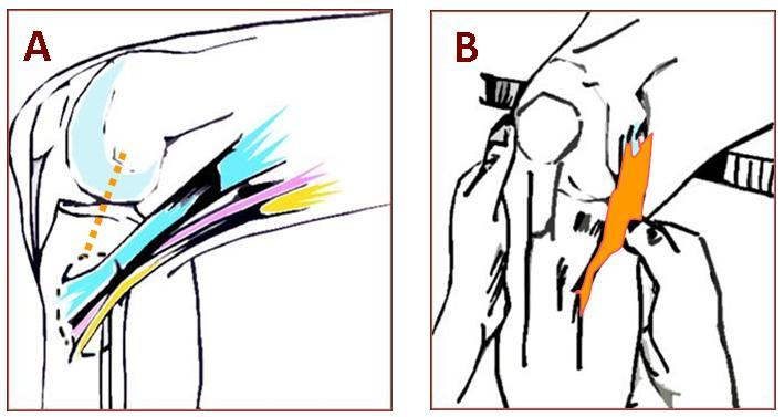 Desde la interlínea articular medial hacia abajo se palpa los tendones de los músculos que constituyen de la Pata de Ganso Superficial: Sartorio (Fig. 4A ) el más anterior, el Recto Interno (Fig.