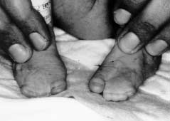 065 recién nacidos vivos gitanos, lo que da una frecuencia del síndrome en este grupo étnico de 1,81 por 10.000 RNV.
