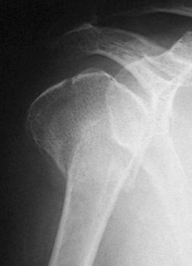 Figura 5. Radiografía preoperatoria de una fractura en 3 partes. Figura 6. Control a las 4 semanas de la intervención.