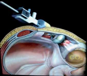 Plastia inguinal: Abordaje laparoscópico totalmente extraperitoneal (TEP) el espacio preperitoneal.