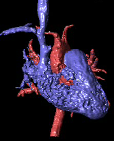 Las proyecciones angiográficas de (a) superficie sombreada y de (b,c) máxima intensidad de señal (MIP) de la angio-rm con contraste intravenoso