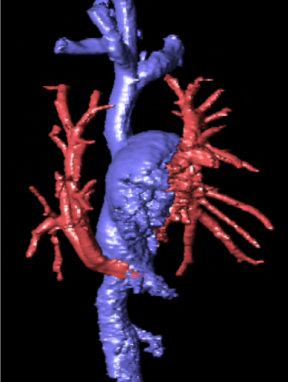 Las proyecciones angiográficas de superficie sombreada (a-c) y de máxima intensidad (MIP) (d-f) de la angio-rm