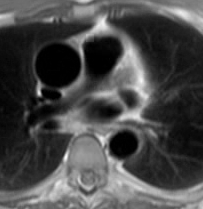 Las imágenes SE-EPI T1 axiales muestran una doble vena cava superior (flechas) y un aneurisma de la raíz de la aorta