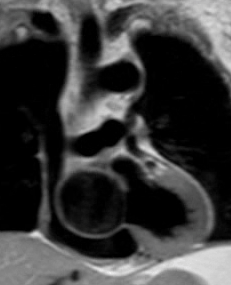 (cruz) y la vena cava superior izquierda (VCSI) se dirige al seno coronario dilatado (flechas punteadas).