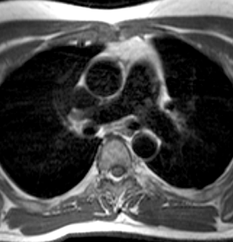 Retorno venoso pulmonar anómalo a la vena innominada izquierda Las venas del lóbulo superior izquierdo o todo el retorno venoso pulmonar izquierdo se conectan a la vena innominada a través de una vía