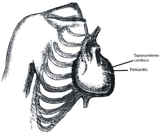 hallar en estos pacientes dilatación de las venas del cuello, la cual es causa de la elevación de la PVC, aunque también puede estar ausente debido a hipovolemia.