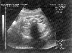 Figura 1. Ecografía fetal mostrando dilatación pélvica renal de 19,8 x 7,8 mm, confirmándose en el período neonatal una estenosis pieloureteral que precisó cirugía correctora permanente.