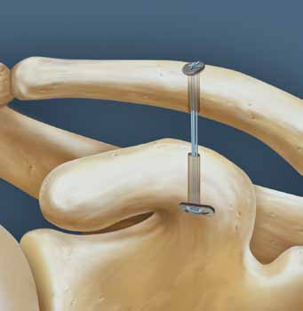 5 6 Tire del alambre pasador de sutura para recuperar las dos suturas blancas de tracción sacándolas por la cánula anterior/inferior.