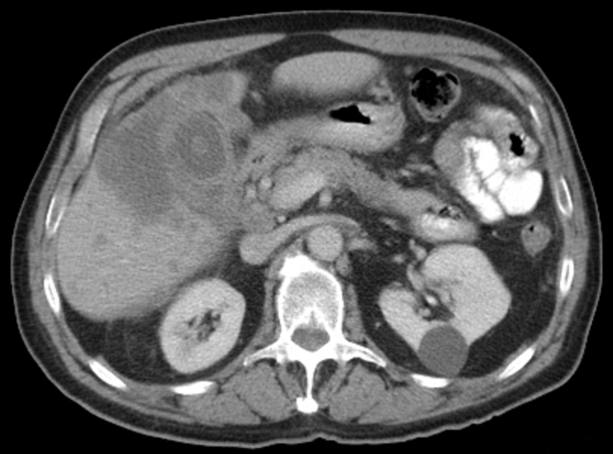Fig. 10: Carcinoma de vesícula.