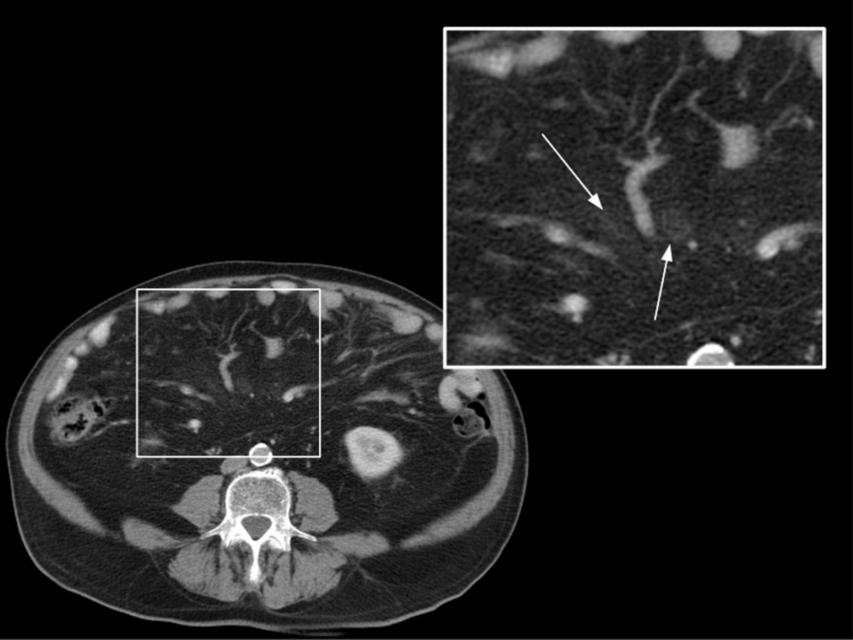 Fig. 18: Carcinomatosis incipiente en paciente con antecedentes de carcinoma colorrectal.