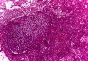 Comunicamos una presentación poco común y escasamente reconocida de un tumor mixto con patrón tipo glándula salival localizado en húmero y luego recidivado en los tejidos blandos