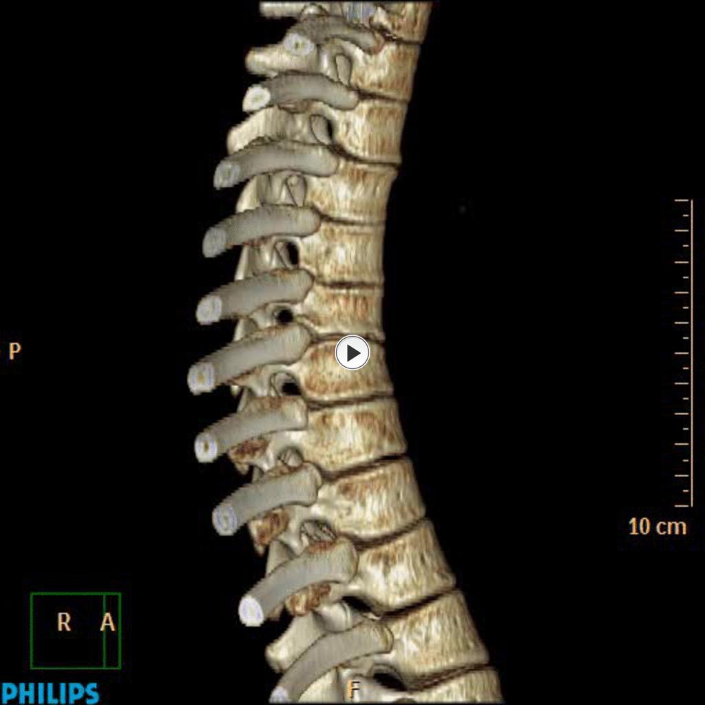 Fig. 22: Vídeo de paciente con sospecha de enfermedad de Scheuermann que muestra la cifosis dorsal de la paciente y la escoliosis por la morfología anómala de platillos vertebrales con presencia de