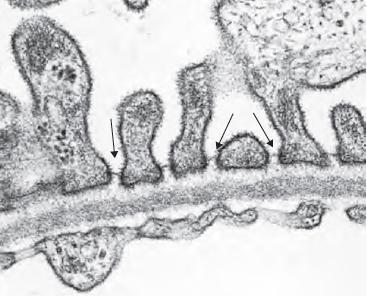 este esquema: - Células endoteliales que forman los capilares. Podemos ver como a lo largo de su citoplasma, en la membrana, hay fenestraciones (para que pueda tener lugar el ultrafiltrado).