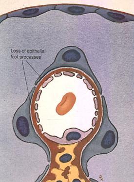 PODICITOPATÍAS NEFROPATÍA POR CAMBIOS MÍNIMOS Se trata de un borrado difuso de las prolongaciones podocitarias del epitelio visceral (visibles a microscopia electrónica) con glomérulos ópticamente