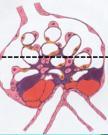 lipoproteínas (si no sabemos que el paciente tiene esta enfermedad ésto pasará desapercibido). En esta imagen a M.E vemos un riñón normal (izquierda) y uno afectado (derecha).