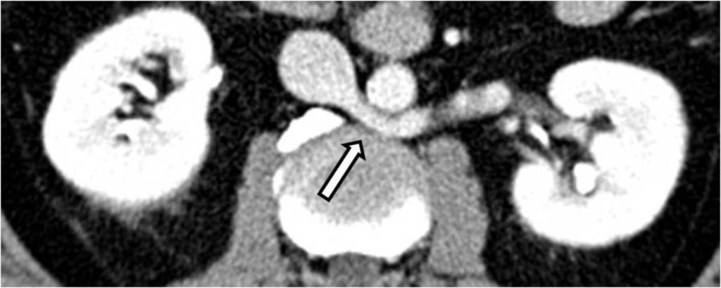 la imagen de la derecha se observa ausencia del segmento hepático de la VCI.