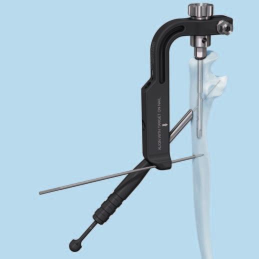 Colocación del implante Opción B: Medición de la longitud del tornillo con el medidor de profundidad para tornillos de 2.7 mm Instrumento 03.