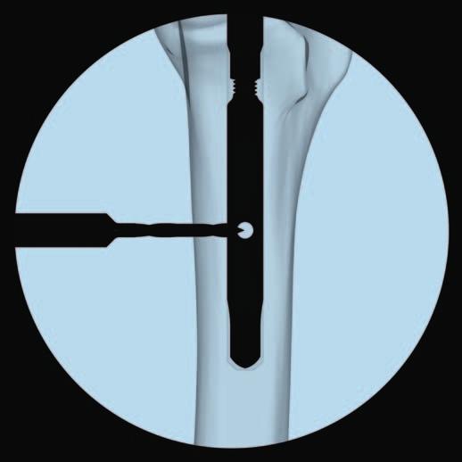 Extracción del implante 2 Extracción de los tornillos de bloqueo y del clavo Instrumento 03.007.