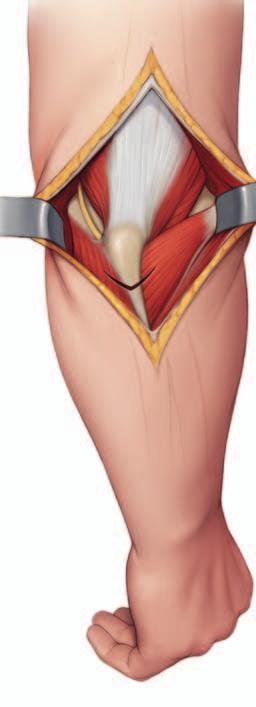 Tríceps Ancóneo Nervio cubital Determine la localización de la osteotomía; para ello, practique una incisión en la cápsula medial, después de retraer el nervio cubital, o la cápsula lateral, después