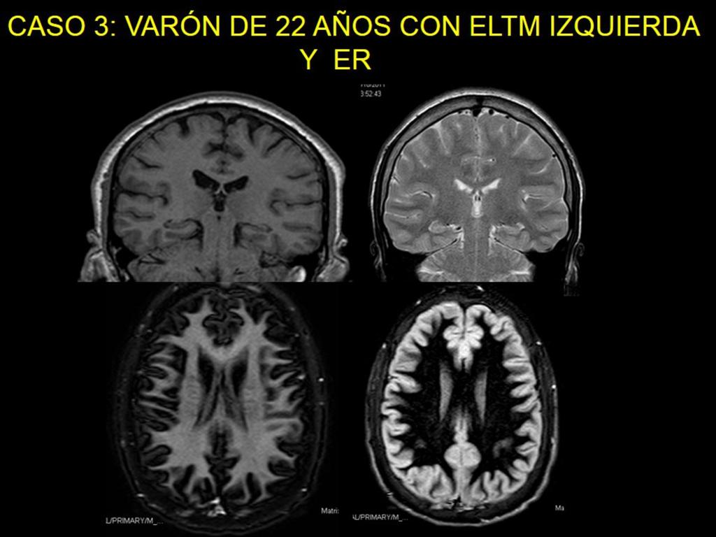 Fig. 13: Paciente varón de 22 años con ELTM izquierda y ER. RM con secuencias coronal 3DT1, coronal T2, axial de sustancia blanca y axial de cortical.