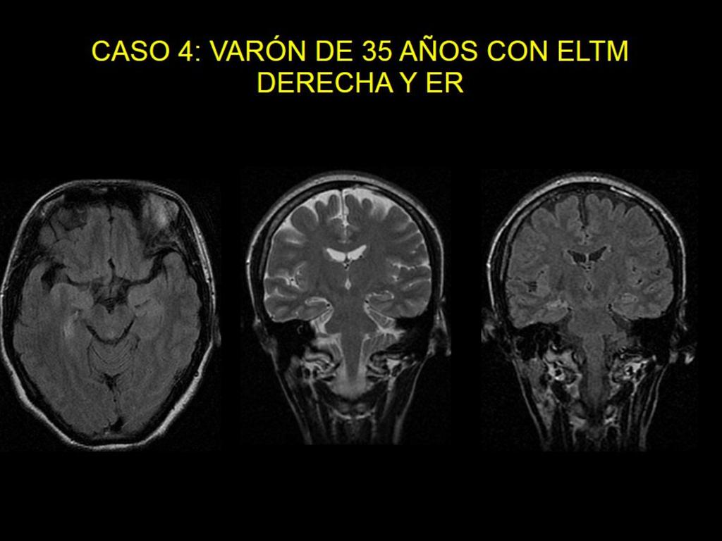 Fig. 15: Paciente varón de 35 años con ELTM derecha y ER RM con secuencias coronal T2 y axial y coronal FLAIR Se aprecia severa atrofia de