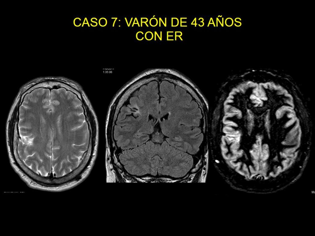 Fig. 19: Paciente varón de 43 años con ER RM con secuencias axial T2, coronal FLAIR y axial de sustancia gris.