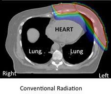 Ca mama izquierda: toxicidad cardiaca Riesgo de 2as neoplasias: Áreas ganglionares afectas < 60 años PCORI: