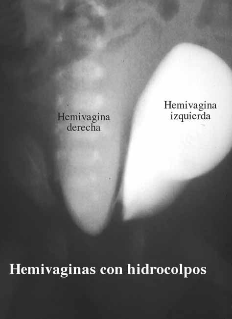 Figura 4. Hiperplasia suprarrenal congénita con uretra masculinizada y resto vaginal mínimo. Figura 3. Cloaca con doble hemivaginas gigantes. ciones vaginales transitorias por estenosis del introito.