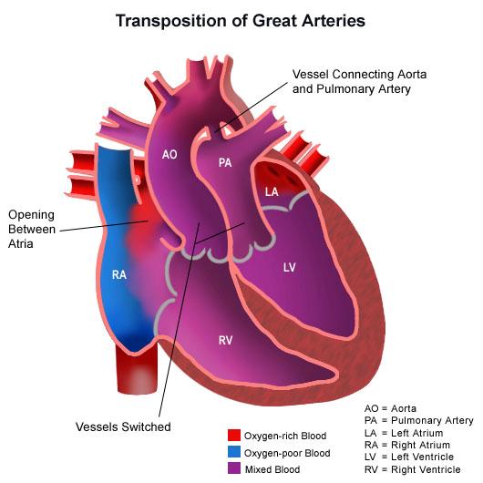 Figura 19. Defectos en la transposición de los grandes vasos La relación entre aurículas y ventrículos es la habitual: la AD se corresponde con el VD y la Al se corresponde con el VI.