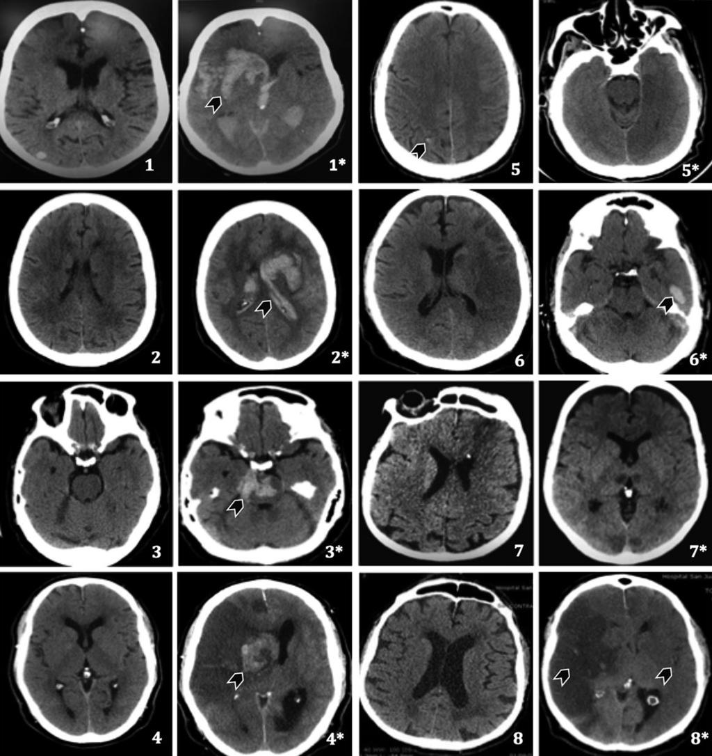 ARTÍCULOS DE INVESTIGACIÓN Figura 3. Cortes axiales de las tomografías computadas (TAC) del cerebro sin contraste de los 8 pacientes fallecidos tomadas antes (1-8) y después (1*-8*) de la trombolisis.