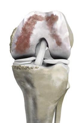 CONOZCA SU RODILLA Para entender los beneficios del enfoque personalizado ConforMIS, es importante entender la anatomía de la rodilla.