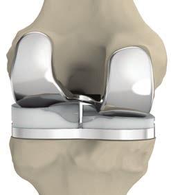 Los implantes de ConforMIS mantienen las líneas mediales y laterales de la articulación del paciente, lo que