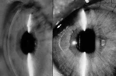 RESULTADOS Y CONCLUSIONES Nuestra experiencia con las lentes precristalinianas de cámara posterior para la corrección de la alta miopía ( 12 a 30 D) se limi- Fig. 18.