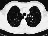 pulmonar (Figura 14). Figura 16. Infarto.
