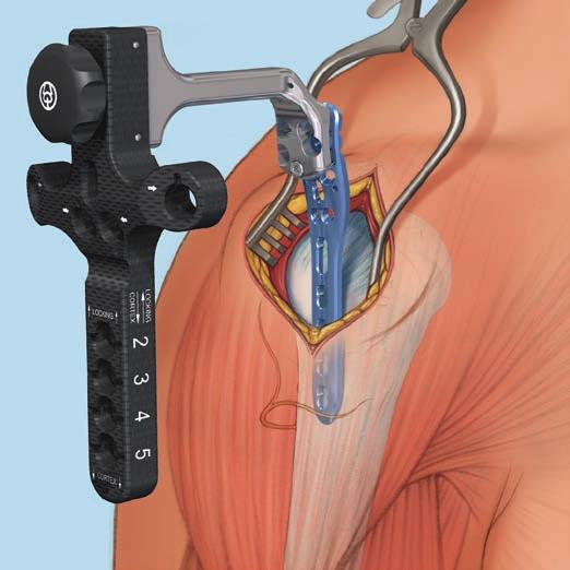 Inserción del implante 4 Inserción de la placa Deslice la placa en el espacio subdeltoideo y a lo largo del hueso. Mantenga siempre la placa en contacto con el hueso.
