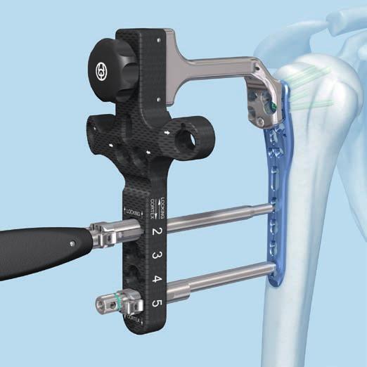 Inserción del implante Implantes: para garantizar la alineación del sistema de mira con la placa, el brazo direccional debe mantenerse fijado a la placa por ambos extremos durante la
