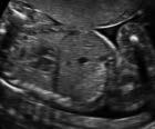 Definir situs: corazón en hemitórax izquierdo, alineado con el estómago. 3º. Evaluar su tamaño ( 1/3 del tórax). Biometría únicamente si hay sospecha de anomalía. 4º.