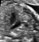 Tracto de salida pulmonar (Fig. 6C): origen en ventrículo derecho (moderator band), más anterior en el tórax, con dirección derecha a izquierda y trayecto cruzado con la aorta.