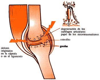 Artrosis Vertebral: 19 Degeneración que sufre la columna
