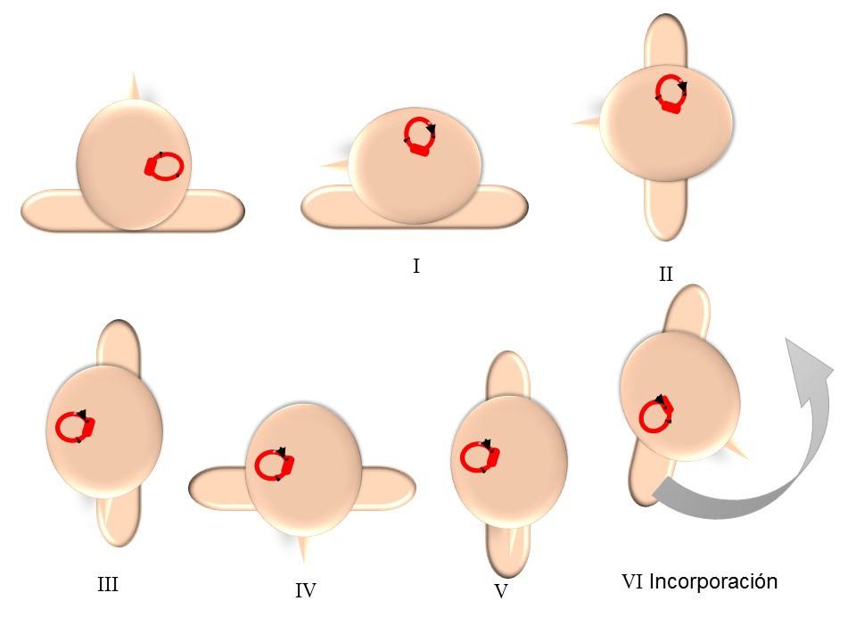 Figura 6: Maniobra de Lempert o de barbacoa para la conductolitiasis del CH, lado derecho. Partiendo de decúbito supino, rotamos al paciente progresivamente hacia el lado sano.