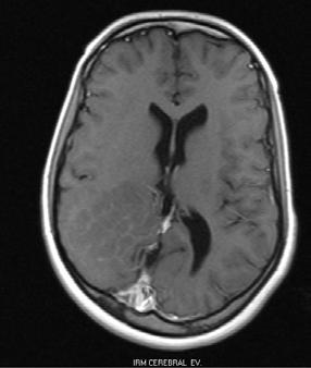 Imagen hipointensa en T1 e hiperintensa en Flair, con igual intensidad de señales que la sustancia gris temporoparietooccipital derecha.