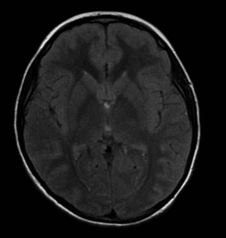Biomédica 2017;37(Supl.1):20-5 Encefalitis autoinmunitaria a. b. c. Figura 2. Resonancia magnética cerebral simple con serie de cortes axiales en secuencia FLAIR de la paciente del caso 2. a. Estudio realizado en el momento de su ingreso al hospital; no se observan alteraciones en el parénquima cerebral.